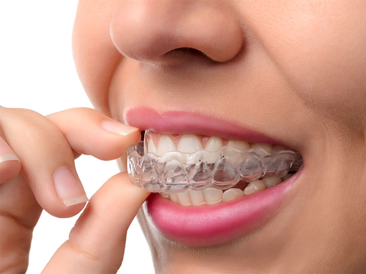 Invisalign Treatments Kelowna