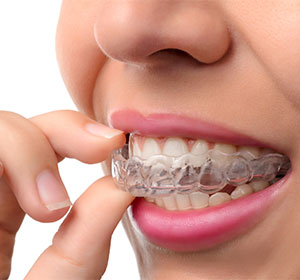 invisalign