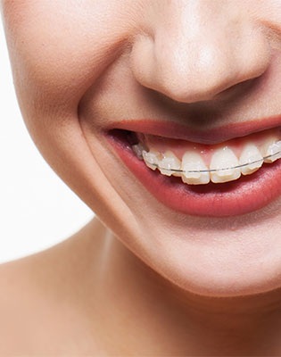 young-person-with-braces